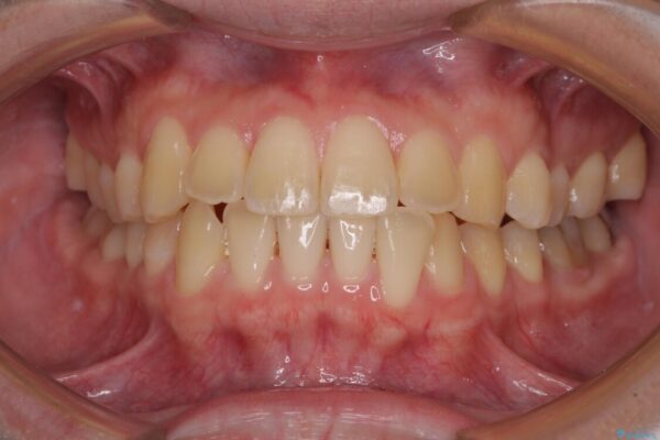 【モニター】前歯のクロスバイトと隙間を改善　インビザラインによる矯正治療 治療途中画像