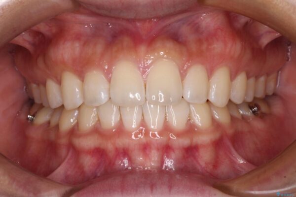 【モニター】前歯のすきっ歯をインビザラインで改善 治療途中画像