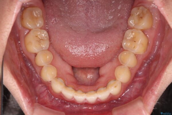 【モニター】前歯のすきっ歯をインビザラインで改善 治療後画像