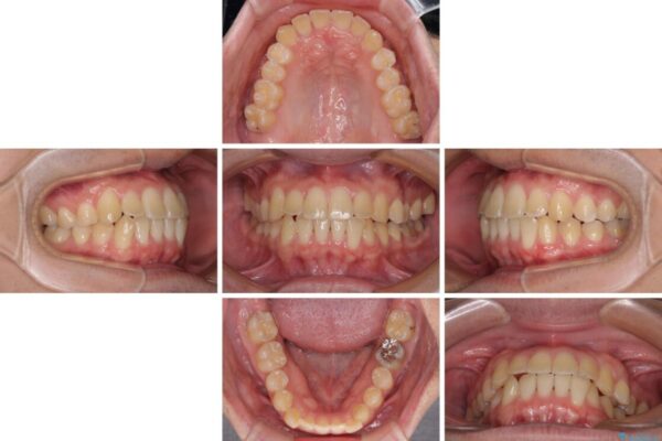 【モニター】前歯のクロスバイトと隙間を改善　インビザラインによる矯正治療 治療途中画像