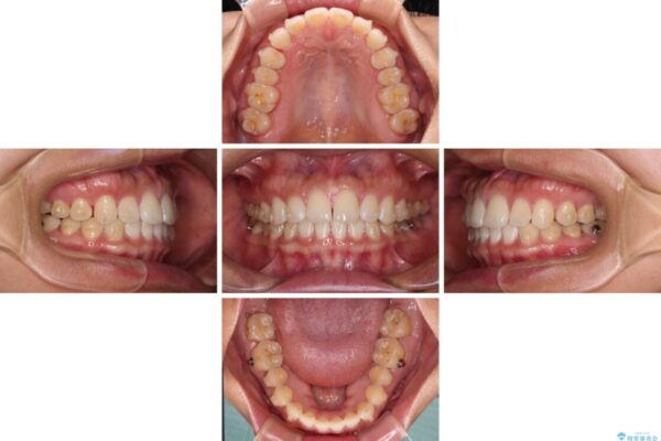 【モニター】前歯のすきっ歯をインビザラインで改善 治療途中画像