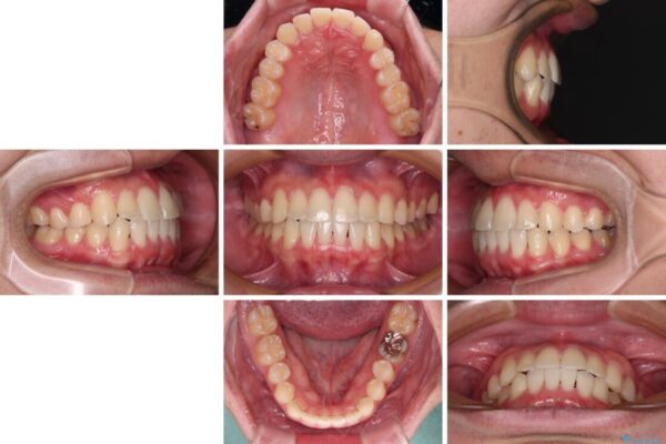 【モニター】前歯のクロスバイトと隙間を改善　インビザラインによる矯正治療 治療後画像