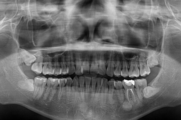 【モニター】前歯のクロスバイトと隙間を改善　インビザラインによる矯正治療 治療前画像