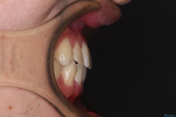 【モニター】前歯のクロスバイトと隙間を改善　インビザラインによる矯正治療 治療後画像