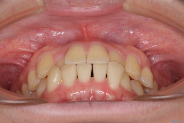 【モニター】前歯のクロスバイトと隙間を改善　インビザラインによる矯正治療 治療前画像