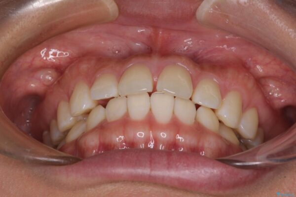 【モニター】前歯のすきっ歯をインビザラインで改善 治療前画像