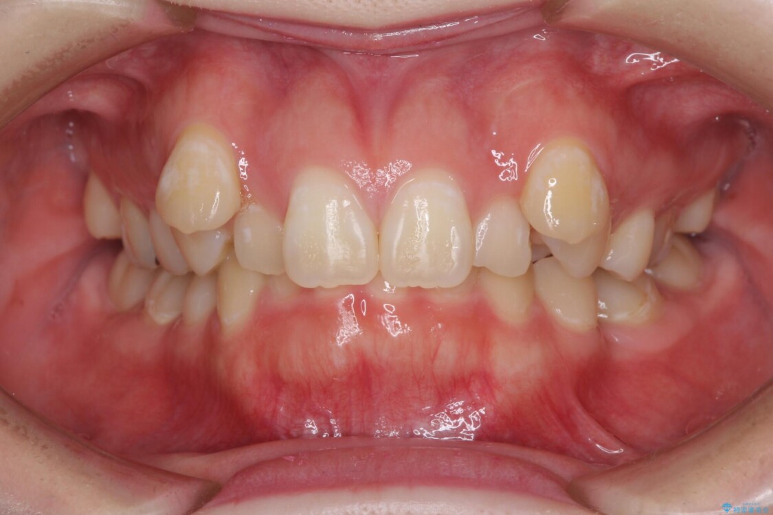 著しい八重歯を短期間で改善　ワイヤー装置による抜歯矯正 治療前
