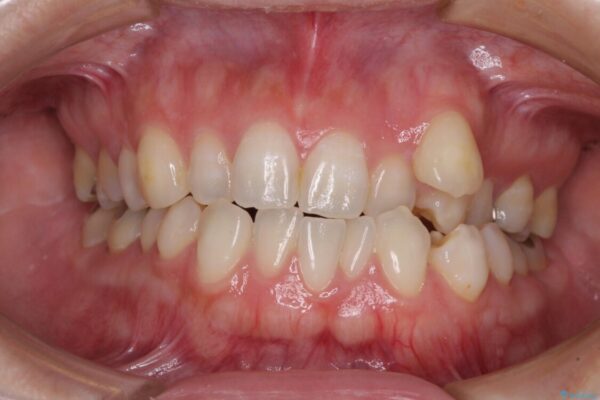 八重歯と前歯の欠損と骨格のズレ　目立たないワイヤー矯正 ビフォー