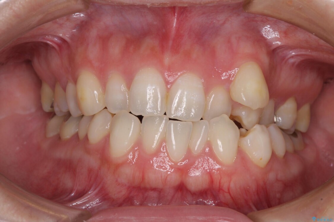八重歯と前歯の欠損と骨格のズレ　目立たないワイヤー矯正 治療前