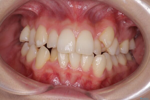 補助装置を併用したインビザラインでの八重歯の抜歯矯正 ビフォー