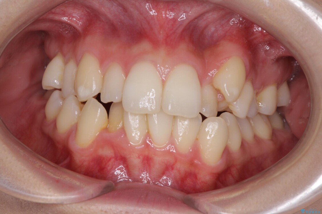 補助装置を併用したインビザラインでの八重歯の抜歯矯正 治療前