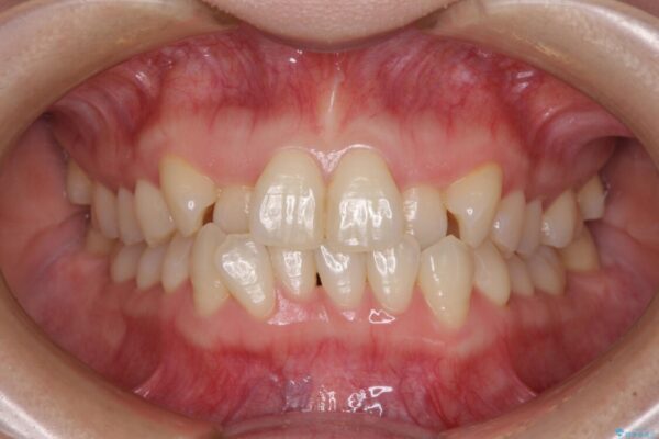 ワイヤー矯正で楽して治療　前歯のデコボコを短期間で改善 治療前画像
