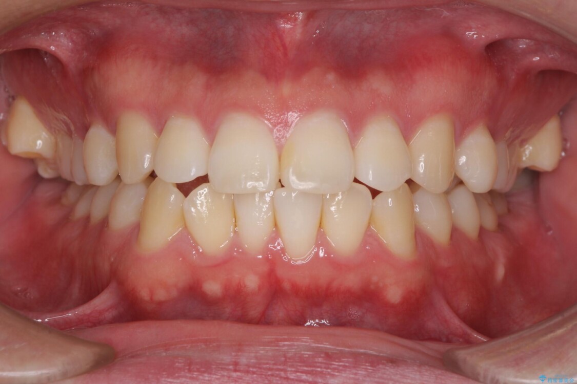 インビザラインで奥歯の咬み合わせと前歯のデコボコを改善 治療前
