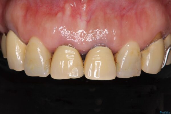 銀歯や入れ歯で汚い歯をきれいにしたい　総合歯科治療 治療前画像