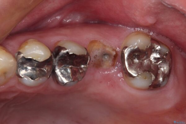 欠損と痛み　奥歯のむし歯治療 ビフォー