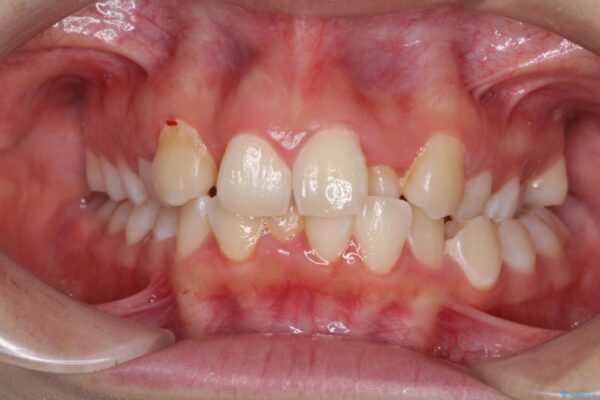 骨格的なズレをカムフラージュ　抜歯矯正で咬み合わせを改善 治療前画像