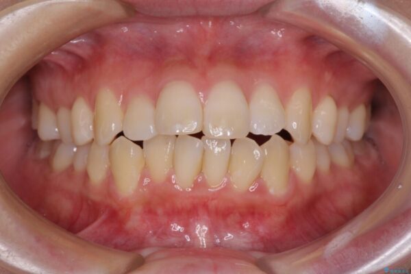 出っ歯を改善　目立たないワイヤー装置での抜歯矯正 治療前画像