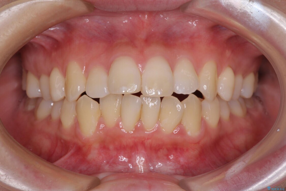 出っ歯を改善　目立たないワイヤー装置での抜歯矯正 治療前