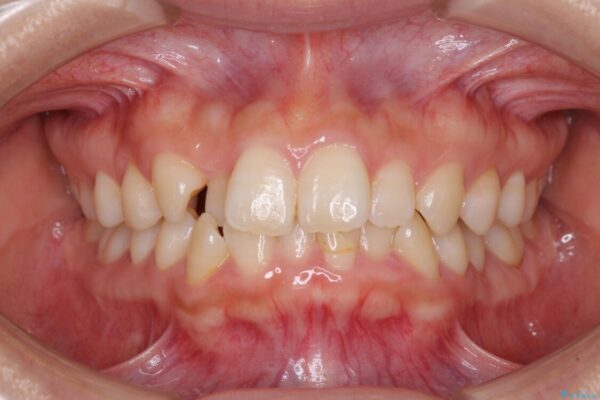 前歯のクロスバイト　目立たないワイヤー装置で速やかに矯正治療 治療前画像