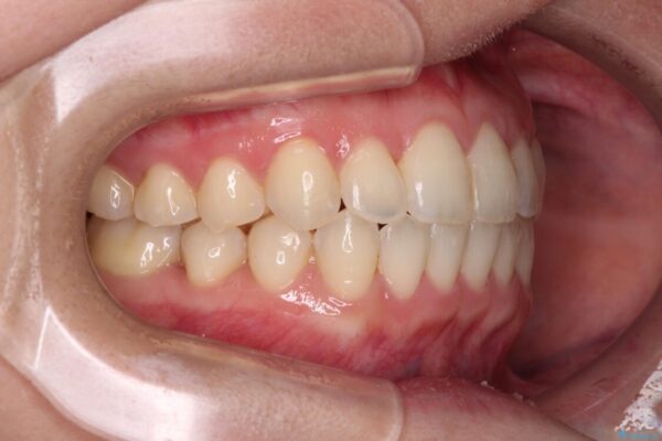 ワイヤー矯正で楽して治療　前歯のデコボコを短期間で改善 治療後画像