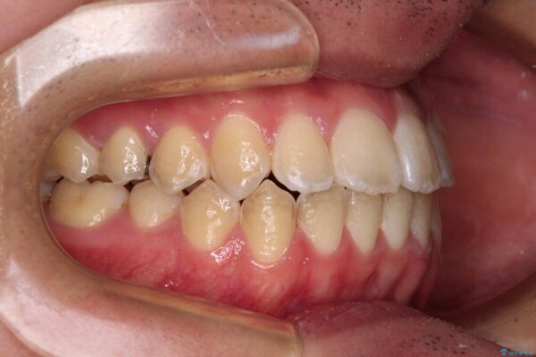 非抜歯ワイヤー装置による、短期間での矯正治療 治療後画像