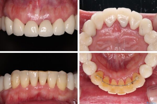銀歯や入れ歯で汚い歯をきれいにしたい　総合歯科治療 治療後画像