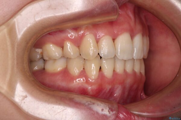 Eラインを改善したい　ハーフリンガルによる抜歯矯正 治療後画像