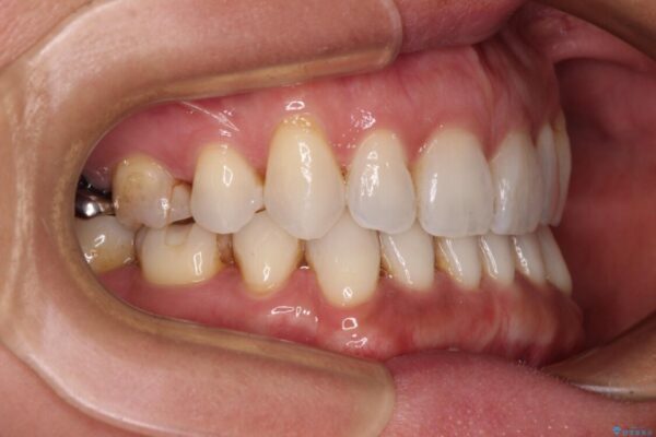 抜歯矯正の後戻りをインビザライン・ライトで解消 治療後画像