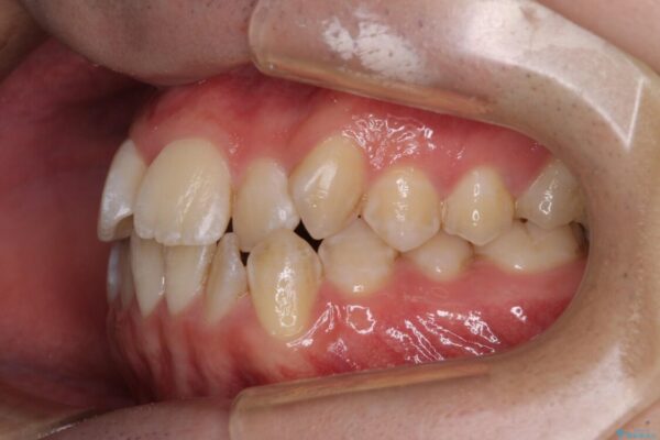 非抜歯ワイヤー装置による、短期間での矯正治療 治療前画像