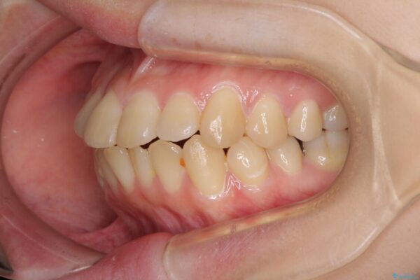 上下の出っ歯を治したい　ワイヤー装置による抜歯矯正 治療前画像