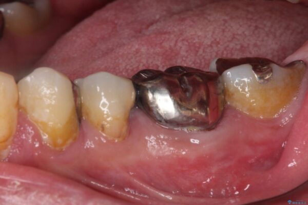 欠損と痛み　奥歯のむし歯治療 治療前画像
