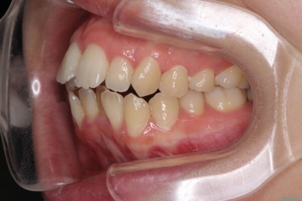 Eラインを改善したい　ハーフリンガルによる抜歯矯正 治療前画像
