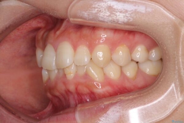 前歯のクロスバイト　目立たないワイヤー装置で速やかに矯正治療 治療前画像