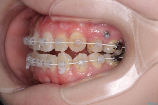 八重歯と前歯の欠損と骨格のズレ　目立たないワイヤー矯正 治療途中画像