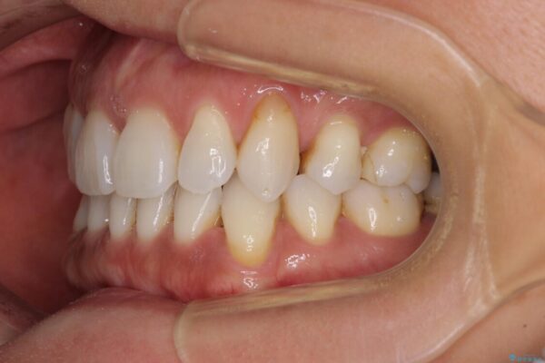 抜歯矯正の後戻りをインビザライン・ライトで解消 治療前画像