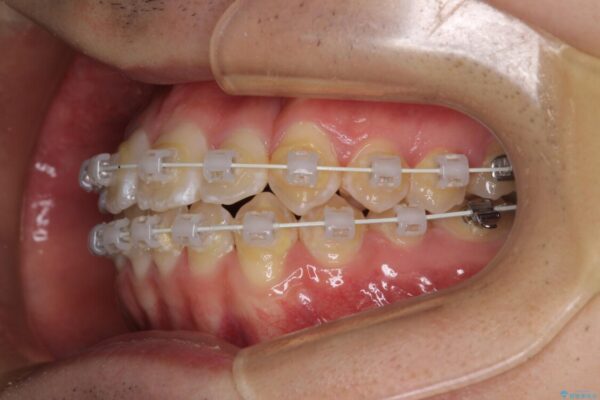 非抜歯ワイヤー装置による、短期間での矯正治療 治療途中画像