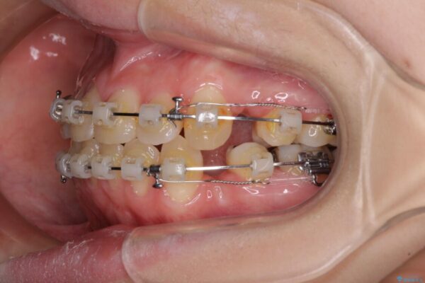 上下の出っ歯を治したい　ワイヤー装置による抜歯矯正 治療途中画像