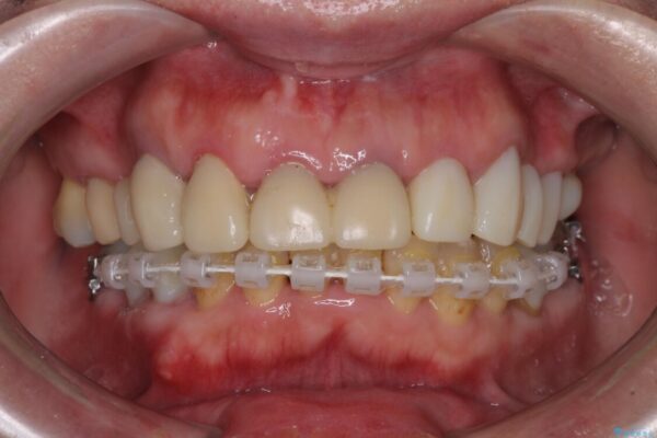 銀歯や入れ歯で汚い歯をきれいにしたい　総合歯科治療 治療途中画像