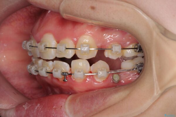 骨格的なズレをカムフラージュ　抜歯矯正で咬み合わせを改善 治療途中画像