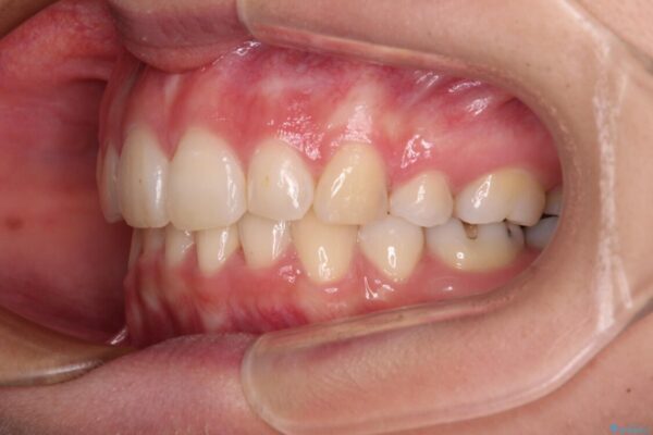 デコボコで飛び出した前歯　ワイヤー装置による抜歯矯正 治療後画像