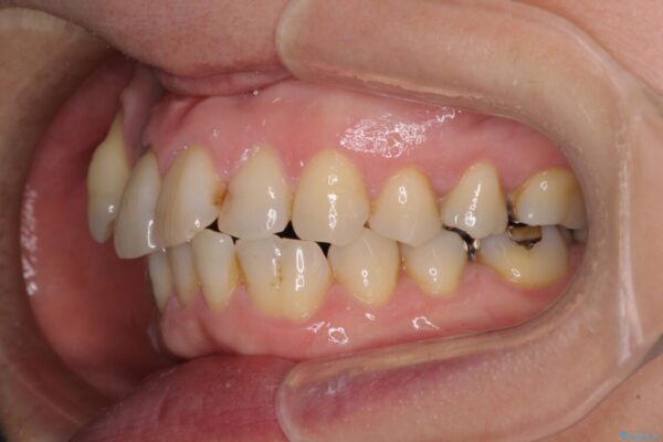 八重歯と形の悪い前歯　矯正治療とセラミック治療 治療前画像