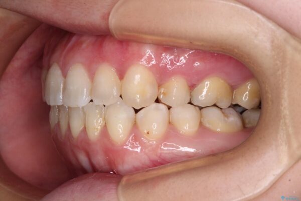 八重歯と前歯の欠損と骨格のズレ　目立たないワイヤー矯正 治療後画像