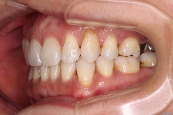 抜歯矯正の後戻りをインビザライン・ライトで解消 治療途中画像