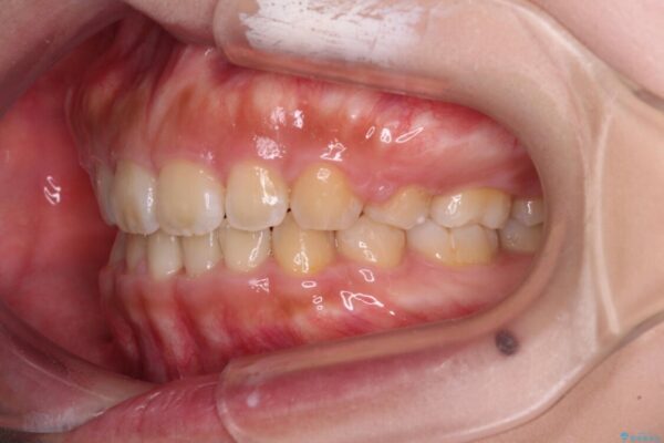口元を引っ込めたい　目立たないワイヤー装置での抜歯矯正 治療後画像