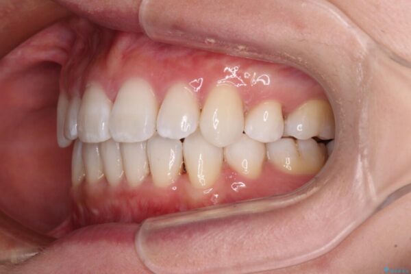 出っ歯を改善　目立たないワイヤー装置での抜歯矯正 治療後画像