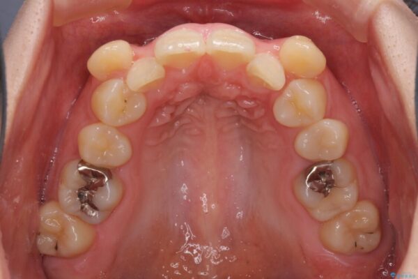 著しい八重歯を短期間で改善　ワイヤー装置による抜歯矯正 治療前画像