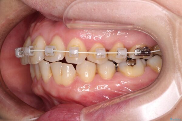 八重歯と形の悪い前歯　矯正治療とセラミック治療 治療途中画像