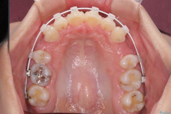 デコボコで飛び出した前歯　ワイヤー装置による抜歯矯正 治療途中画像