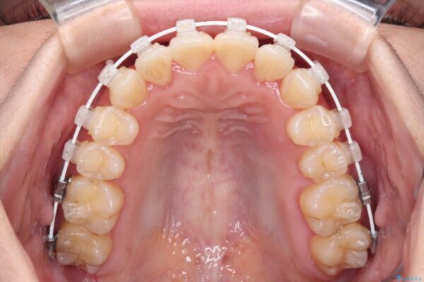 ワイヤー矯正で楽して治療　前歯のデコボコを短期間で改善 治療途中画像