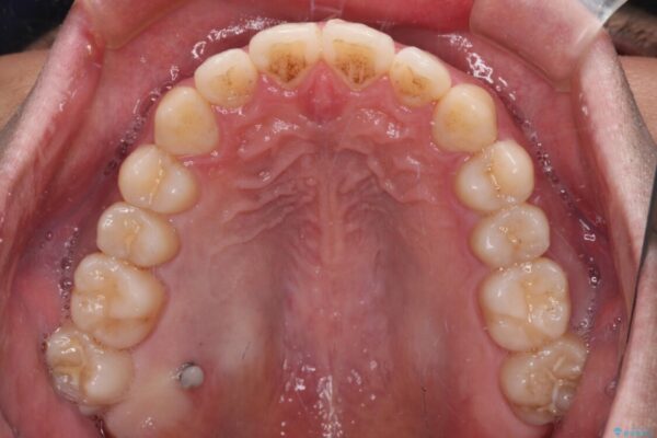 インビザラインで奥歯の咬み合わせと前歯のデコボコを改善 治療途中画像